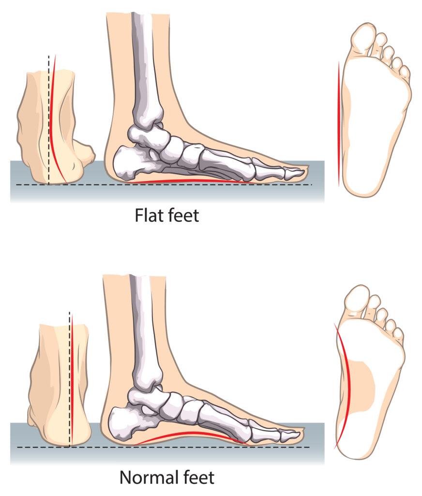 Panduan⁤ Memahami Flat ‍Foot dan⁤ Kebutuhan Khususnya ‌dalam Pemilihan Sepatu